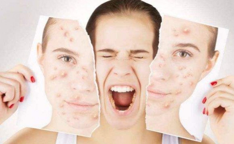 什么是激素臉？你的臉有中激素的毒嗎？ 美容護膚獨生美官網