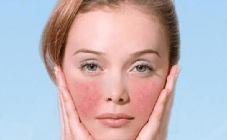 激素臉和過敏臉區別在哪兒？激素臉有哪些癥狀？激素臉怎么治療修復好得快？美容護膚獨生美官網